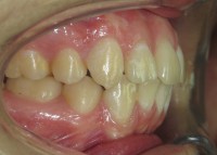 /album/caso-n%c2%b02-ortodoncia-despues/web-1-jpg3/